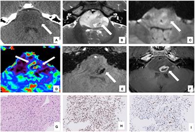 Extra-neural metastases in pediatric diffuse midline gliomas, H3 K27-altered: presentation of two cases and literature review